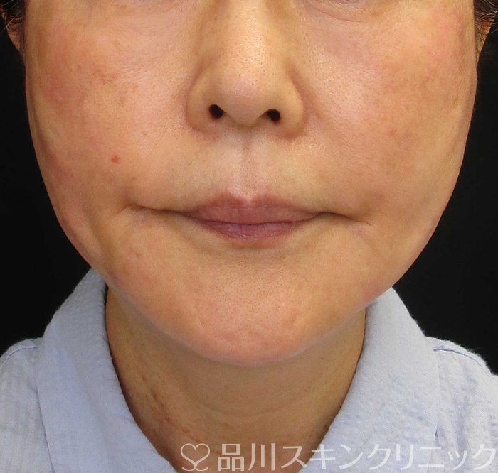 症例NO.68051のAFTER写真