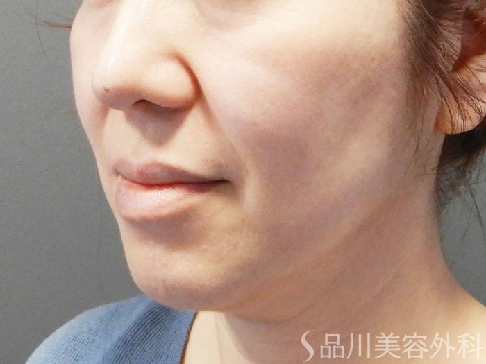症例NO.75075のBEFORE写真