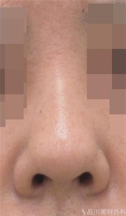 症例NO.22952のBEFORE写真
