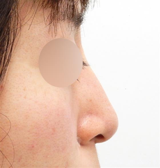 症例NO.53149のAFTER写真