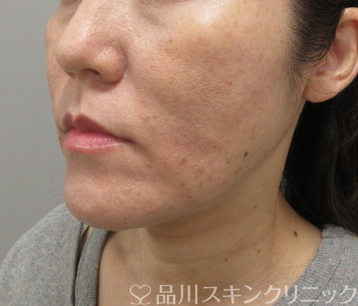 症例NO.73644のAFTER写真