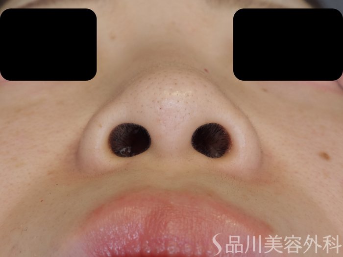 症例NO.70387のBEFORE写真