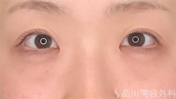 症例NO.60979のBEFORE写真