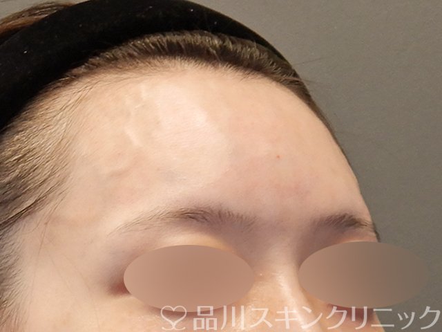 症例NO.75351のAFTER写真