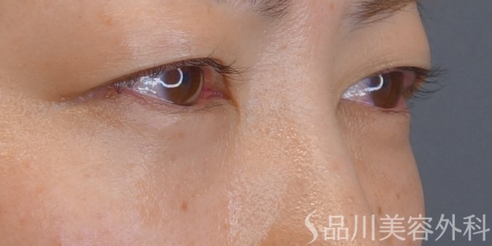 症例NO.72943のAFTER写真