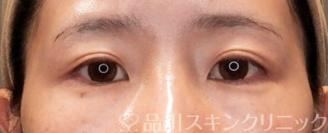 症例NO.70551のBEFORE写真