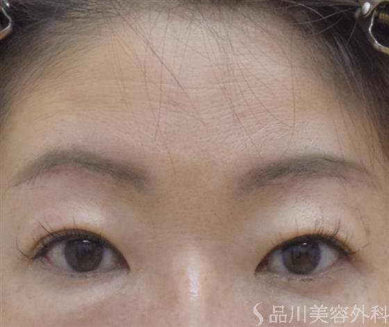 症例NO.52697のAFTER写真