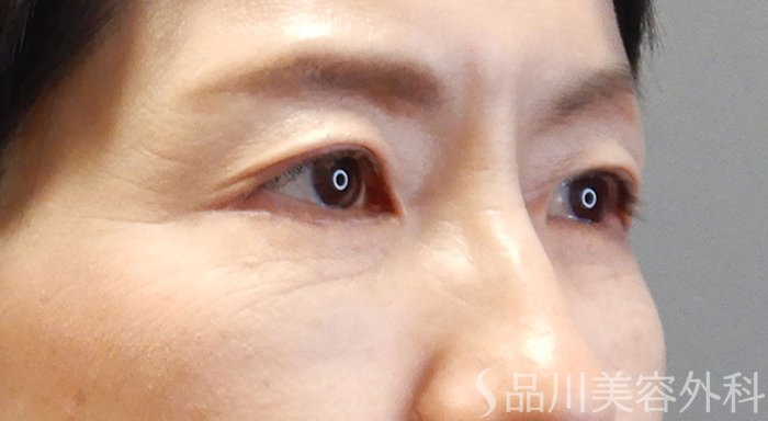 症例NO.70529のAFTER写真