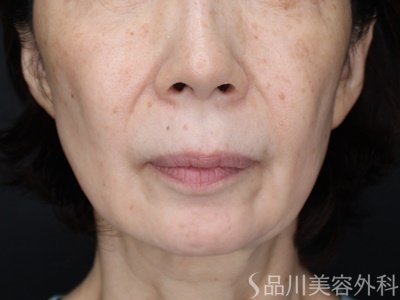 症例NO.71302のBEFORE写真