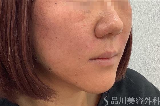 症例NO.55368のAFTER写真