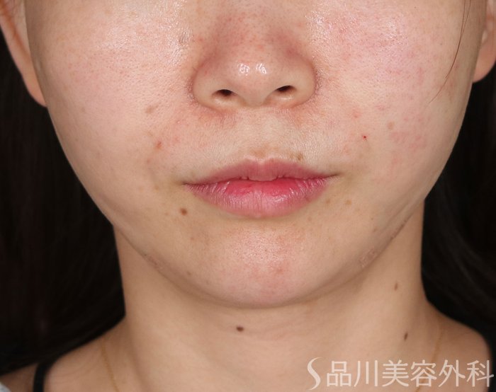 症例NO.73345のAFTER写真