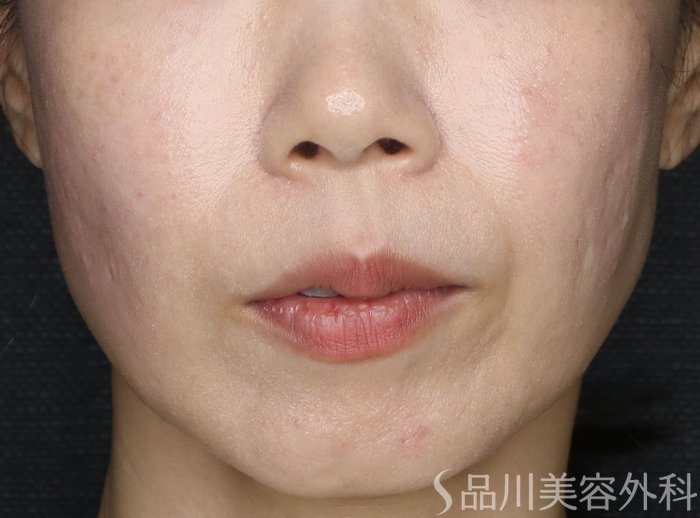 症例NO.73740のAFTER写真