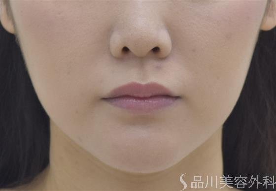 症例NO.44615のAFTER写真