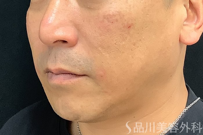 症例NO.71214のAFTER写真
