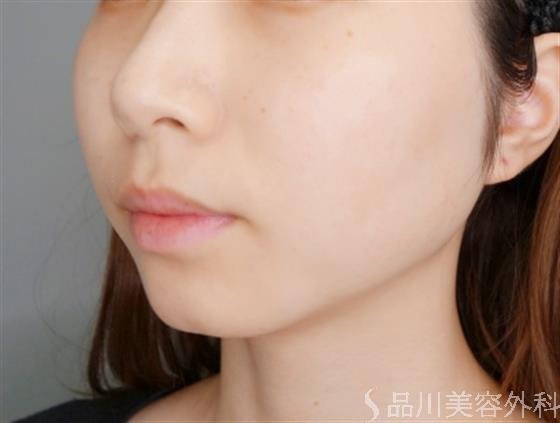 症例NO.54150のBEFORE写真