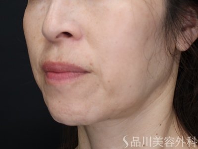 症例NO.72699のBEFORE写真