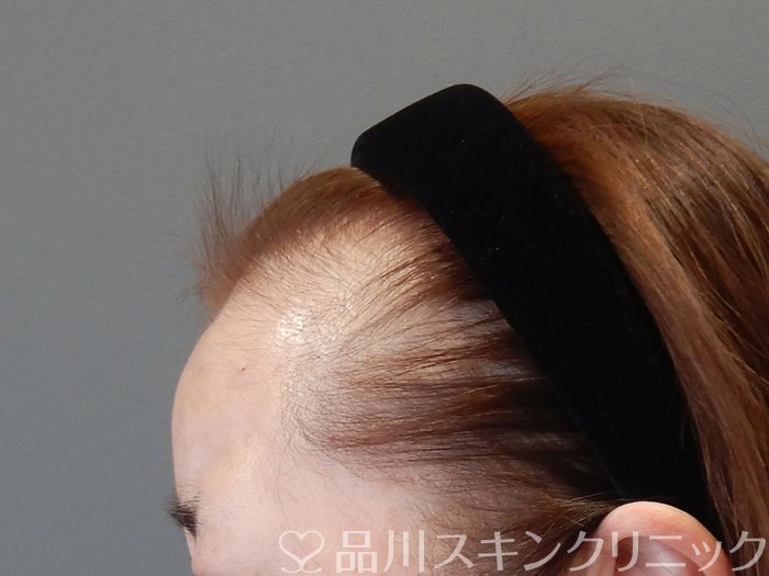 症例NO.73039のAFTER写真