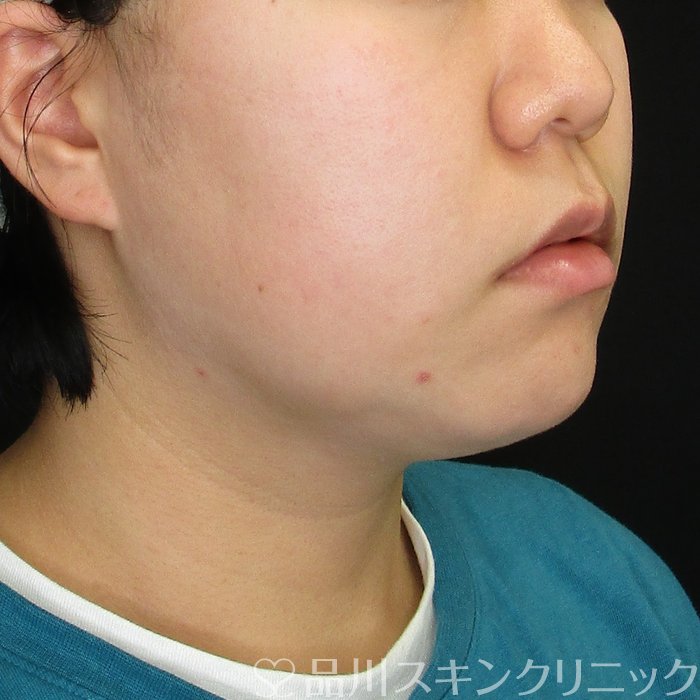 症例NO.74899のBEFORE写真