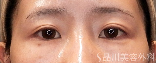 症例NO.70551のBEFORE写真