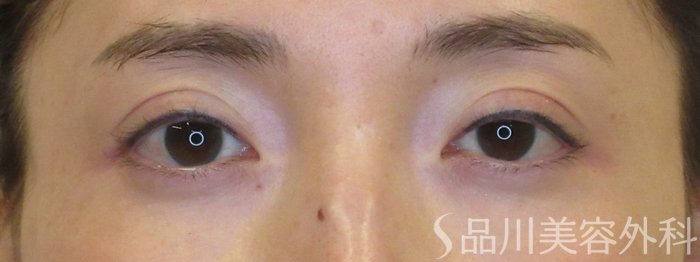 症例NO.72068のAFTER写真