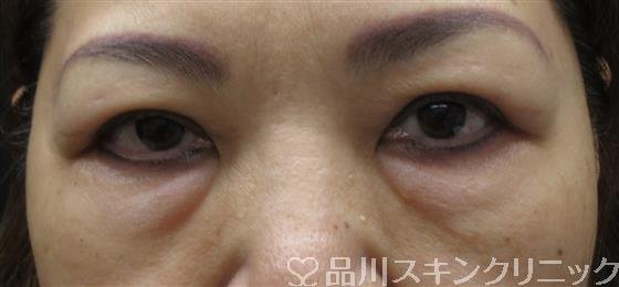 症例NO.61439のBEFORE写真