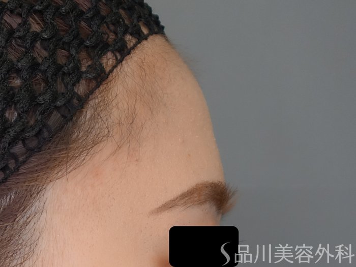 症例NO.70854のBEFORE写真