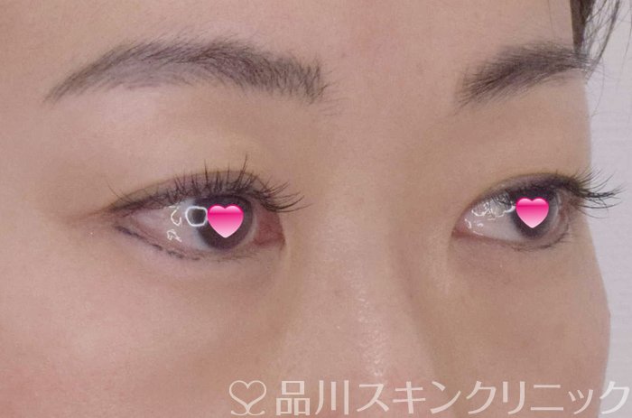 症例NO.65062のBEFORE写真