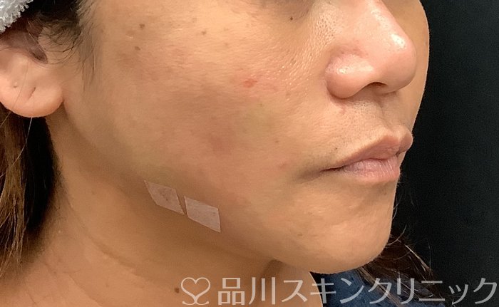 症例NO.69378のAFTER写真