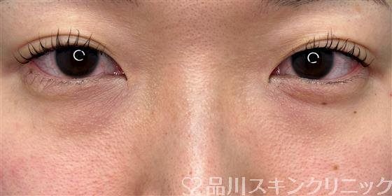 症例NO.60888のBEFORE写真