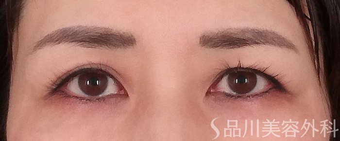 症例NO.70078のBEFORE写真