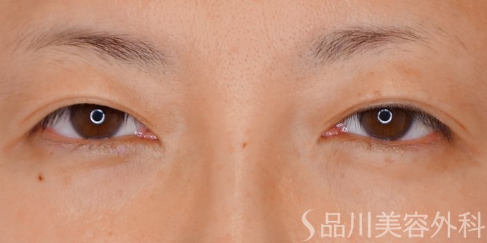 症例NO.69650のBEFORE写真
