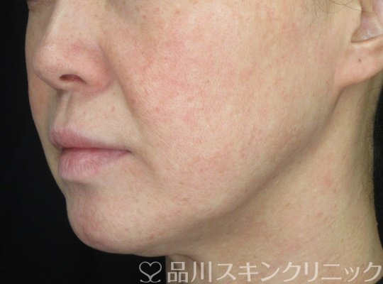 症例NO.70077のBEFORE写真