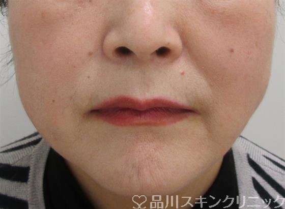 症例NO.42238のAFTER写真