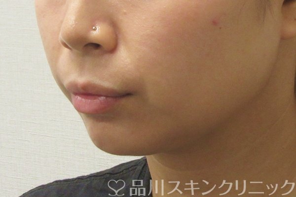 症例NO.74505のBEFORE写真