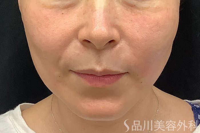 症例NO.71252のAFTER写真