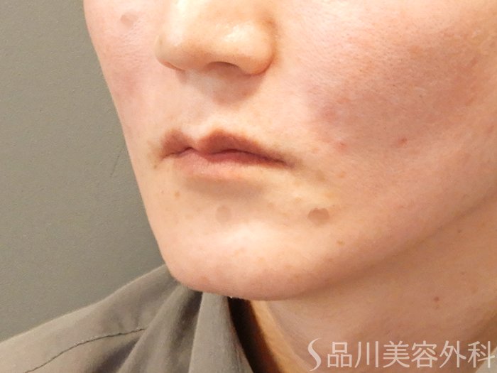 症例NO.70204のAFTER写真
