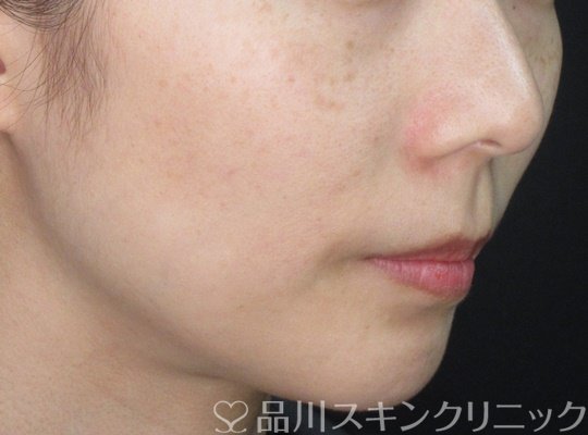症例NO.70711のAFTER写真