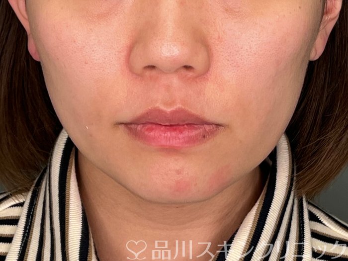 症例NO.69896のBEFORE写真