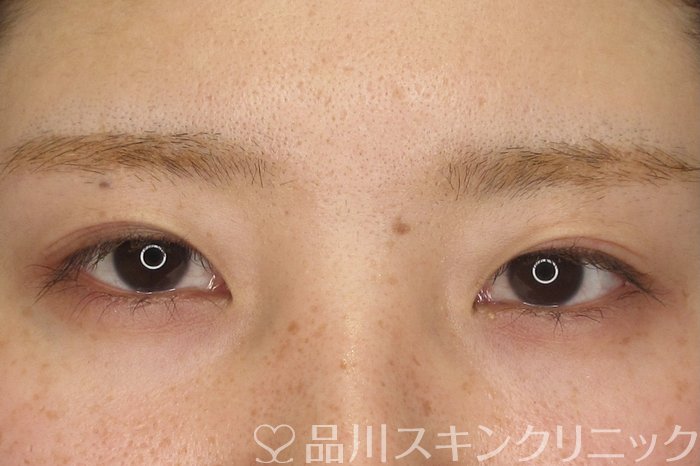 症例NO.69211のBEFORE写真