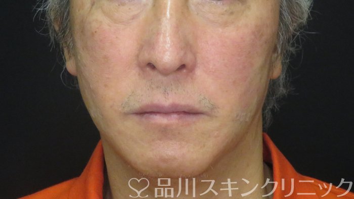 症例NO.73480のAFTER写真