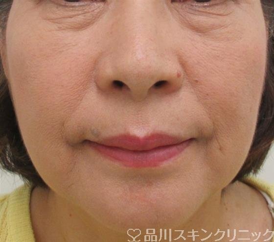 症例NO.26429のBEFORE写真