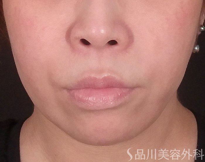症例NO.71443のBEFORE写真