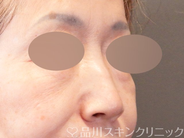症例NO.67107のBEFORE写真
