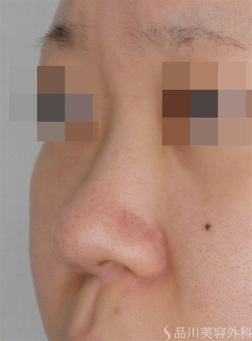 症例NO.49499のBEFORE写真