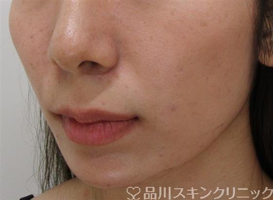 症例NO.36920のAFTER写真
