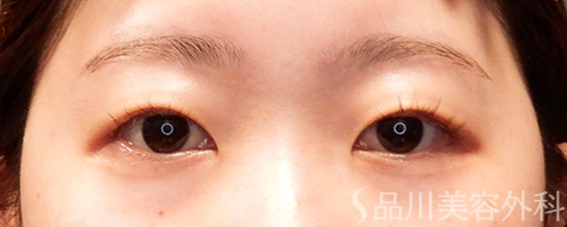 症例NO.69366のBEFORE写真