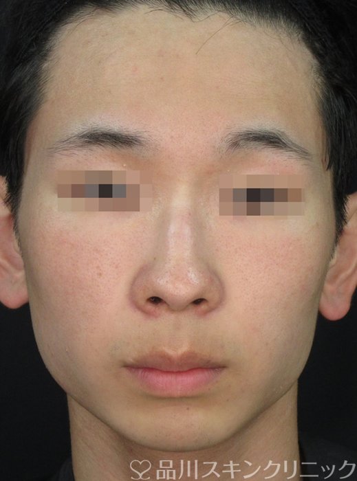 症例NO.73057のAFTER写真