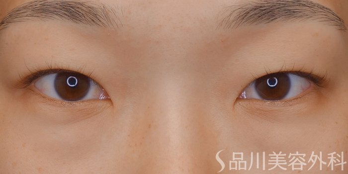 症例NO.71685のBEFORE写真
