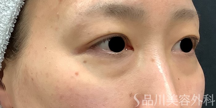 症例NO.69662のBEFORE写真