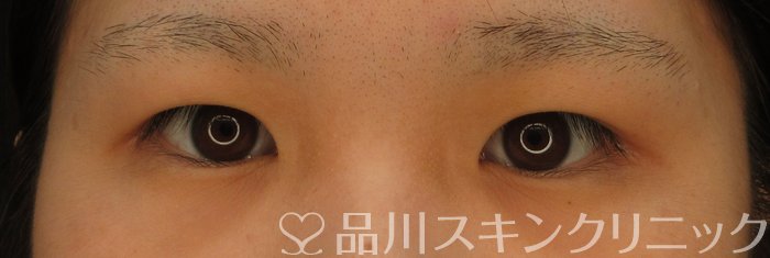 症例NO.63011のBEFORE写真